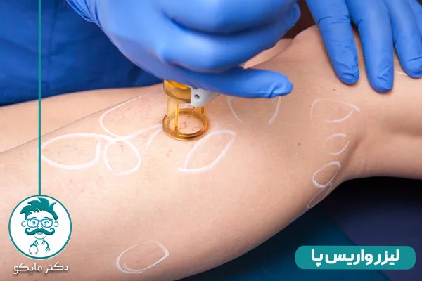 معجزه درمان سریع واریس