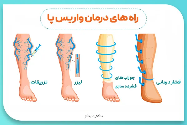 درمان واریس پا