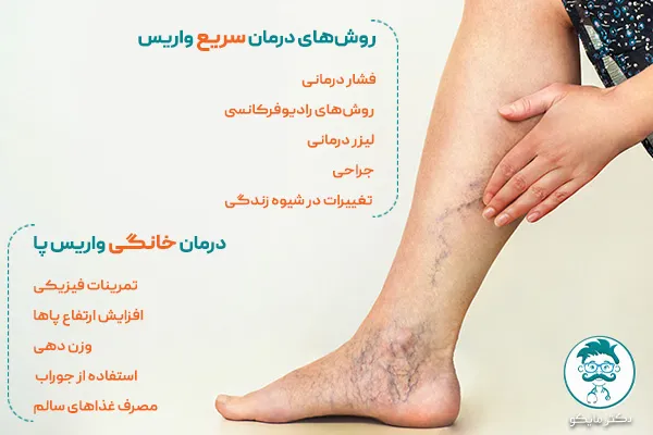درمان سریع واریس 