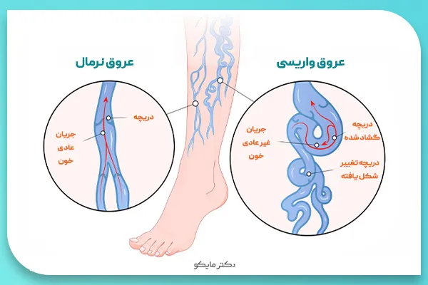 علت واریس پا در جوانی
