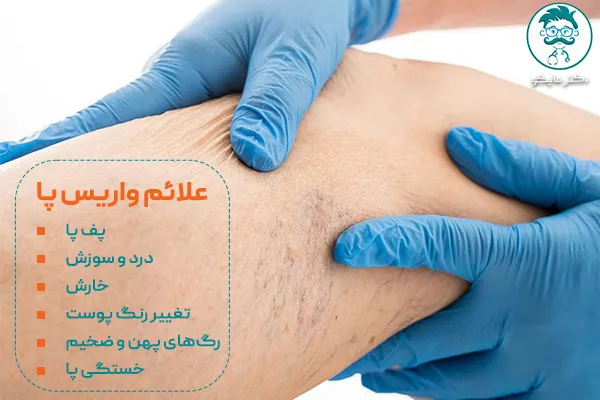 علائم واریس پا