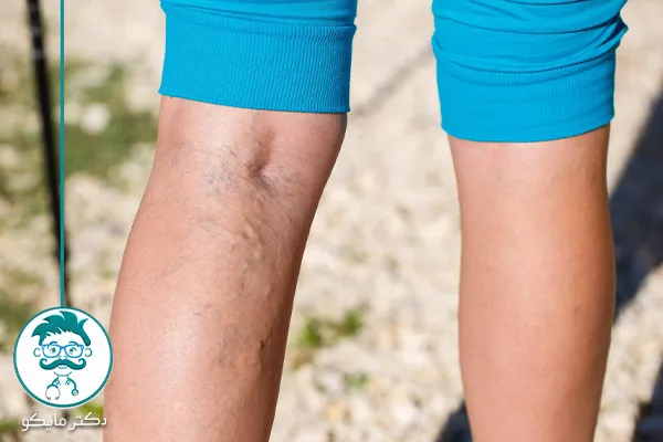 درمان واریس با یخ، زنجبیل، ورزش و ...