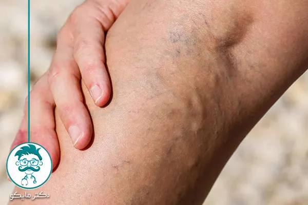 درمان واریس در طب سنتی