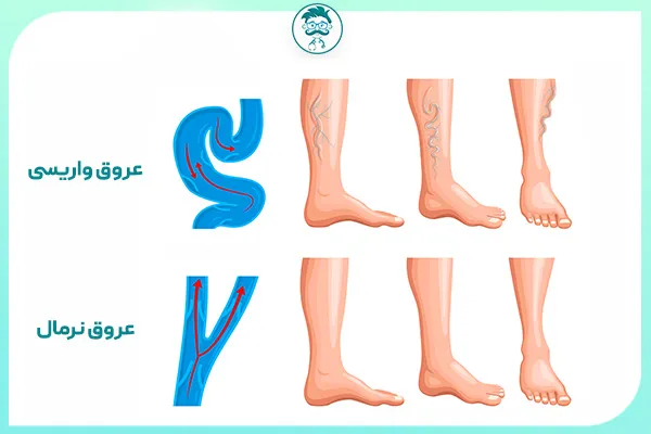 درمان واریس با ورزش
