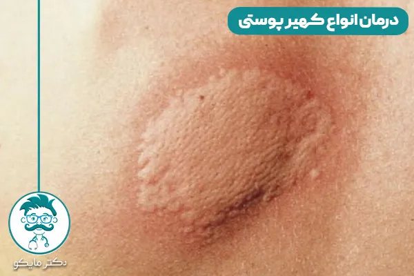 کهیر پوستی چیست؟