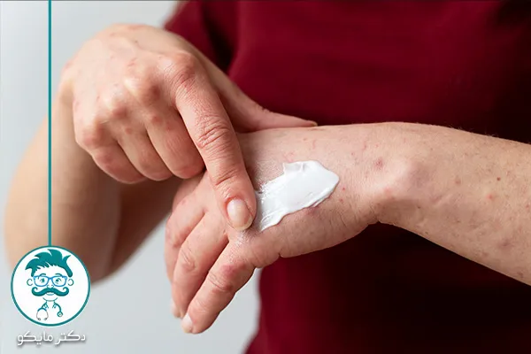 درمان کهیر پوستی