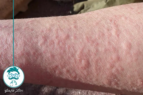 کهیر پوستی گرمایی و سرد 