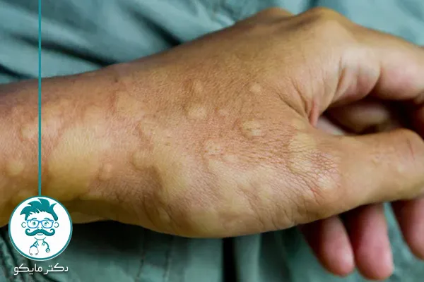 علت ایجاد کهیر در کودکان