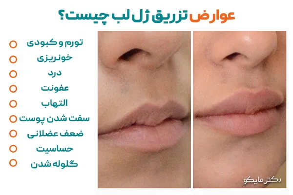 عوارض تزریق ژل لب چیست؟