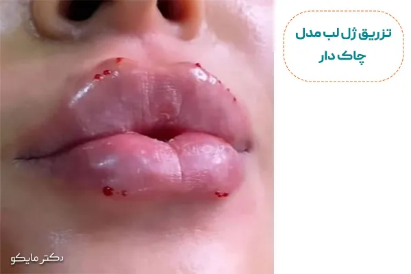 عکس تزریق ژل لب قلوه ای
