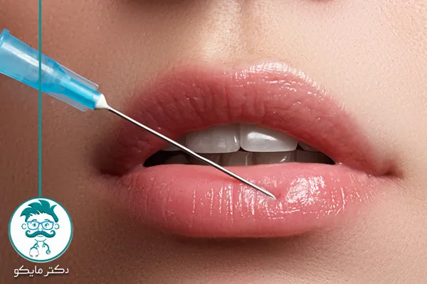مراقبت‌های بعد از تزریق ژل لب