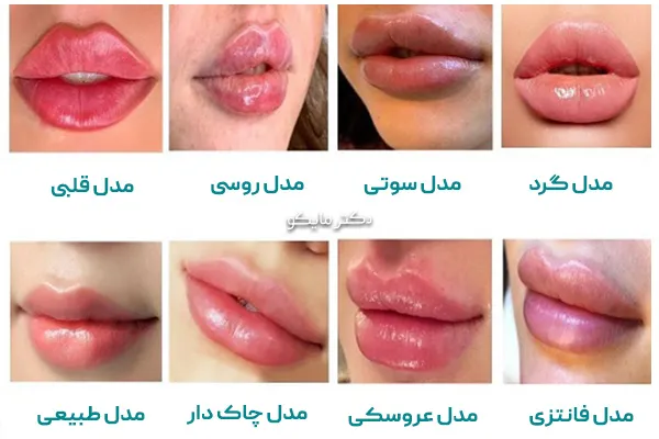 انواع تزریق ژل لب