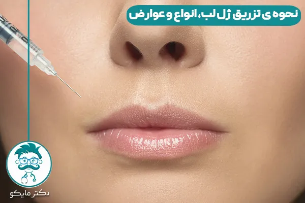 تزریق ژل لب
