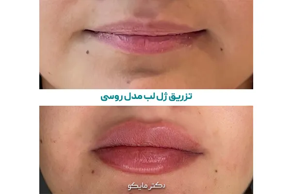 تصویر تزریق ژل لب مدل روسی قبل و بعد