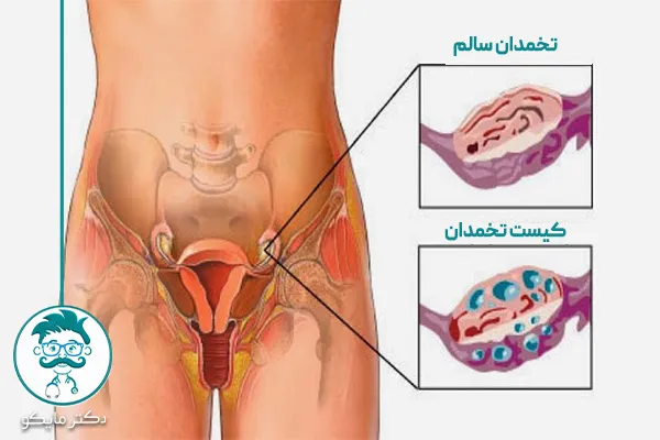 سندروم تخمدان پلی کیستیک
