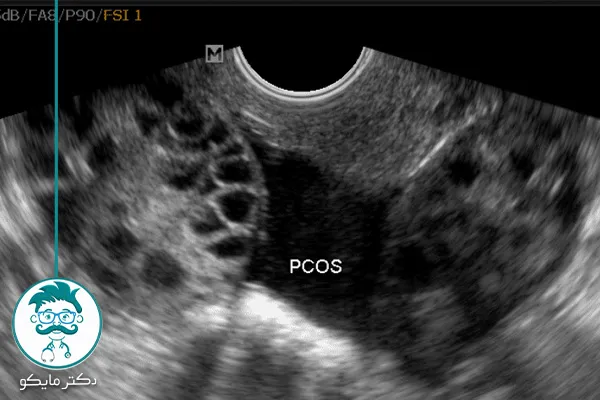 علت کیست تخمدان چیست؟