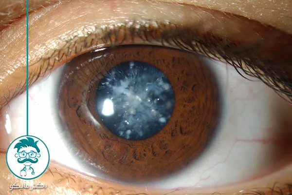 بعد از عمل آب مروارید چشم چه بخوریم؟