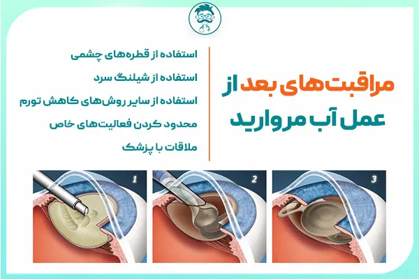 مراقبت‌های بعد از جراحی آب مروارید