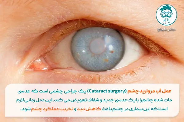 عمل آب مروارید چشم چگونه است؟