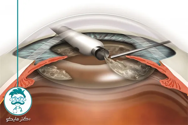 عمل آب مروارید چشم چقدر طول می کشد؟