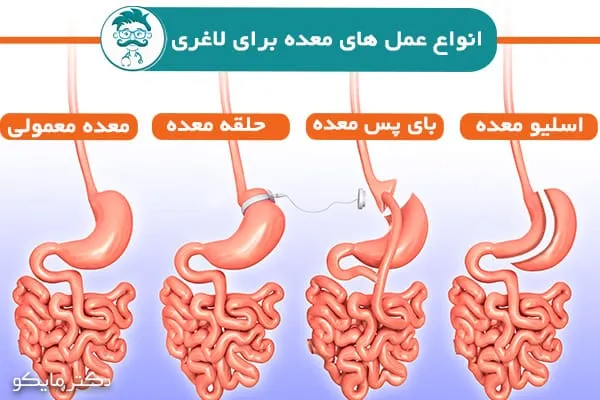 نظرات مردم درباره عمل اسلیو معده+نظرات مردم در مورد عمل معده+نظرات درباره عمل اسلیو معده+اسلیو معده برای چه کسانی خطرناک است