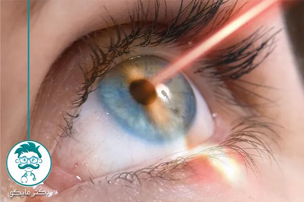 سن مناسب برای عمل لیزیک