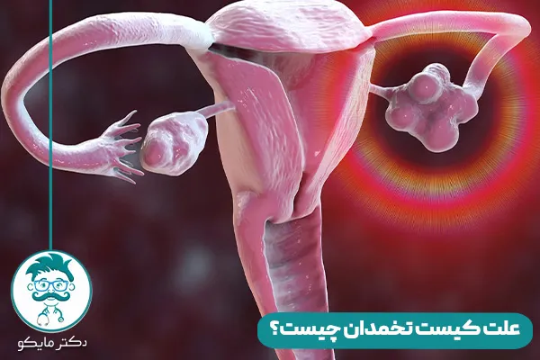 کیست تخمدان چیست؟