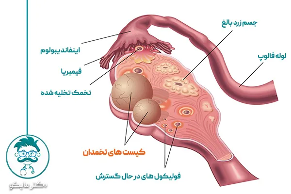 چه اندازه کیست تخمدان خطرناک است؟