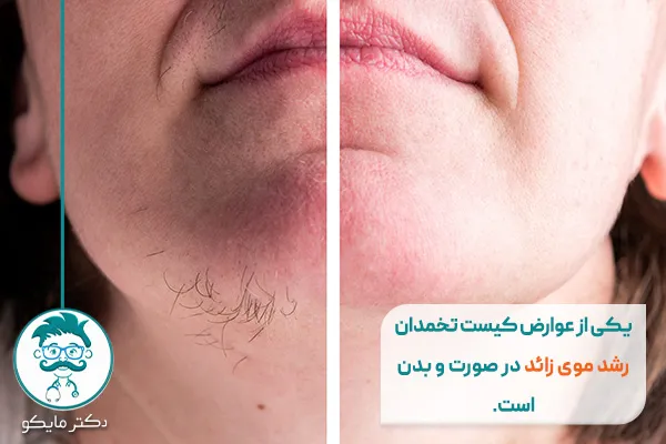 کیست تخمدان و رشد موی زائد 