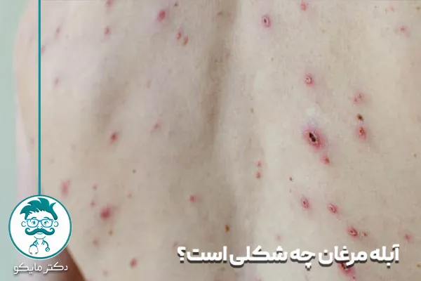 شکل آبله مرغان در بزرگسالان