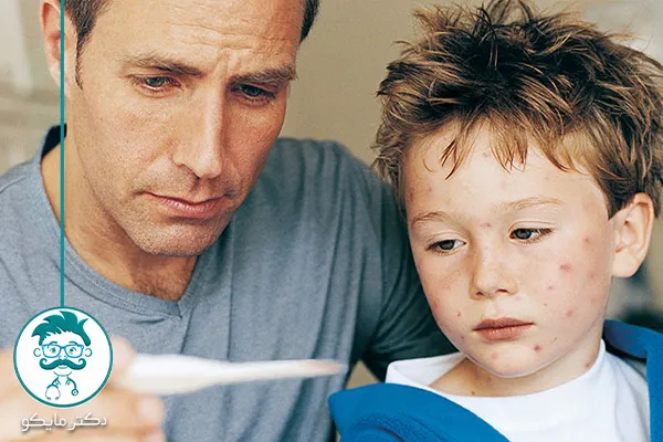 شکل آبله مرغان در کودکان 