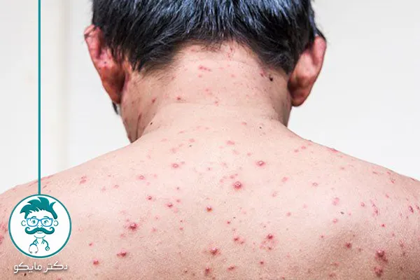 درمان آبله مرغان