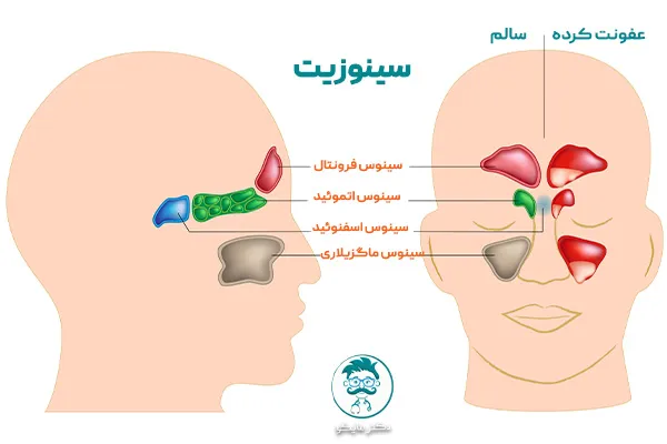 سینوزیت چیست؟