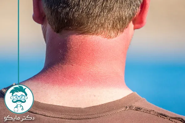 درمان آفتاب سوختگی دریا
