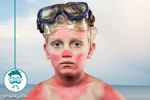 درمان آفتاب سوختگی دریا