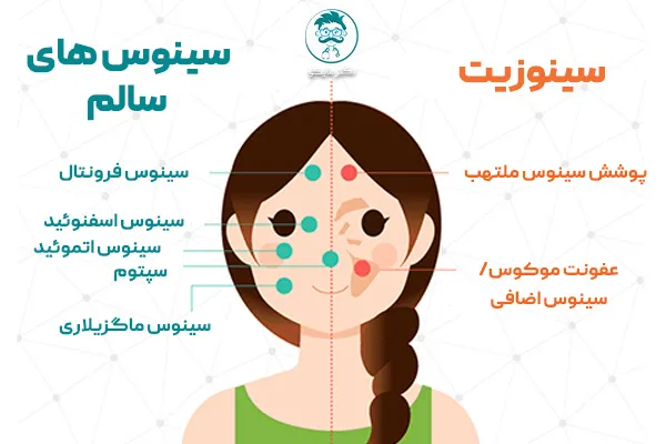 عمل سینوزیت