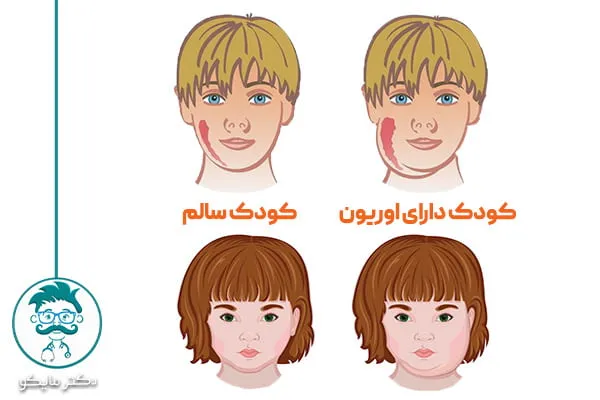 درمان سریع اوریون