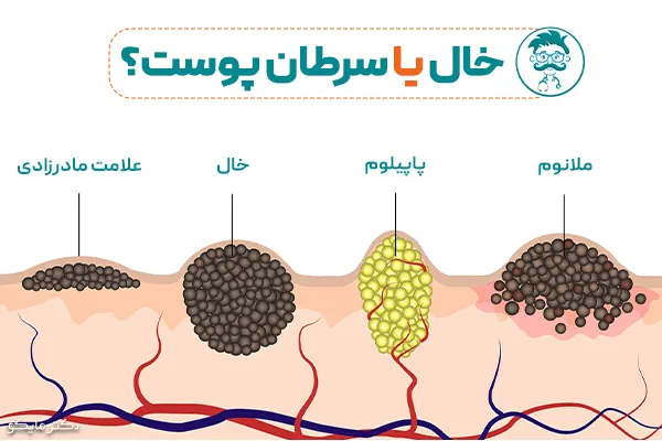 سرطان پوست چیست؟