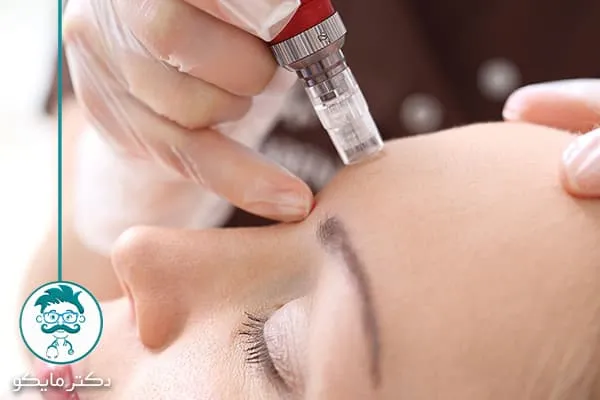 هزینه میکرونیدلینگ