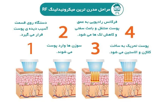 میکرونیدلینگ پوست صورت 