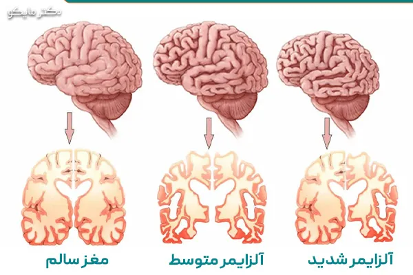 آتروفی مغزی در سالمندان