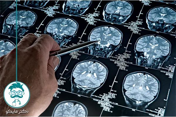 علت کوچک شدن مغز چیست؟