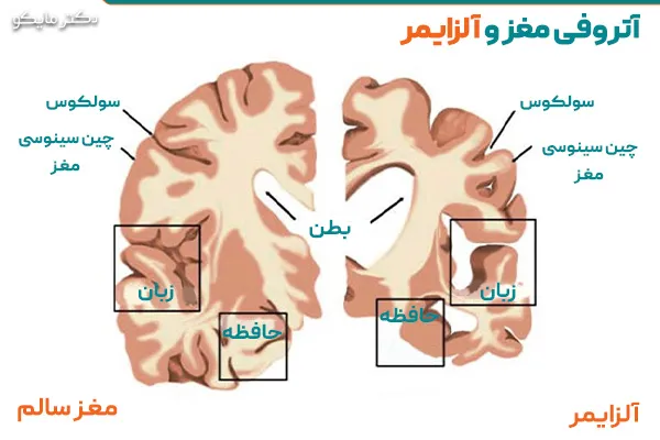 آتروفی مغز درمان دارد؟