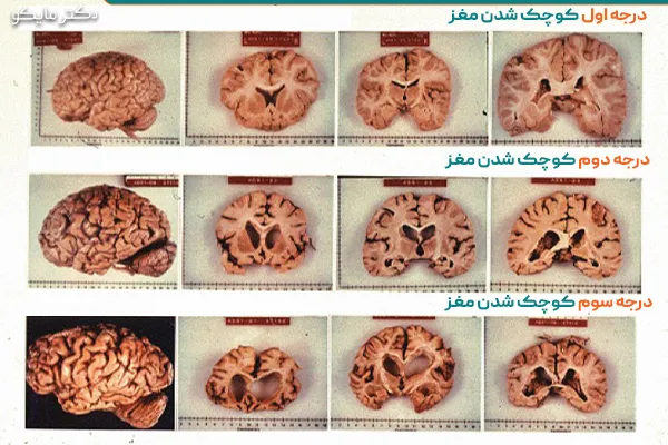 درجات کوچک شدن مغز 