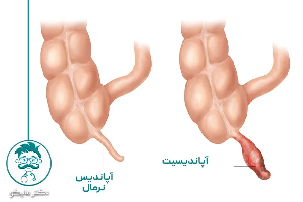تست آپاندیس در منزل