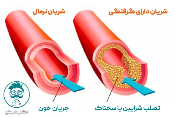 گرفتگی رگ قلب چیست؟