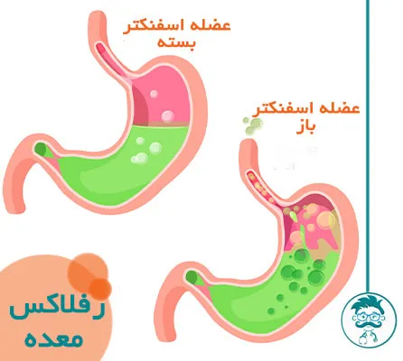 بیماری ریفلاکس معده به مری (GERD):