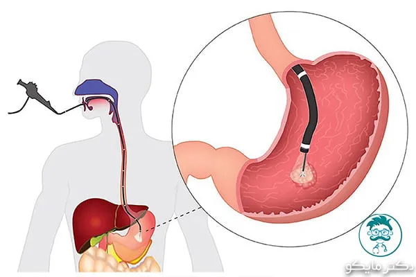 تحلیل جواب آندوسکوپی معده