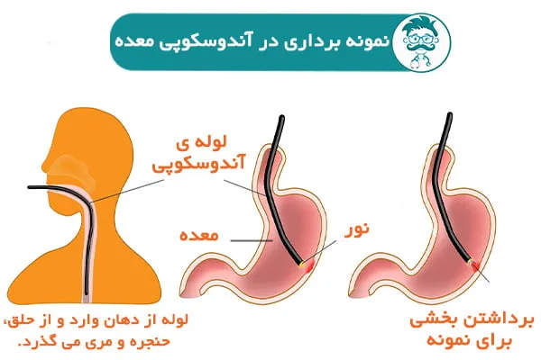 هزینه آندوسکوپی معده با بیهوشی