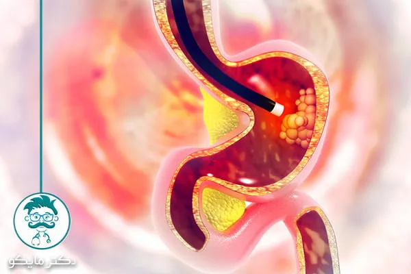 قبل و بعد از آندوسکوپی معده چه بخوریم؟